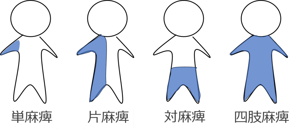 麻痺